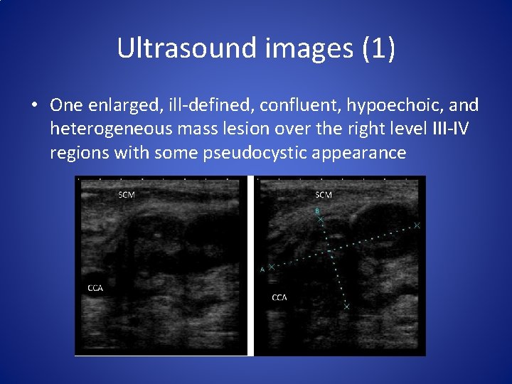 Ultrasound images (1) • One enlarged, ill-defined, confluent, hypoechoic, and heterogeneous mass lesion over