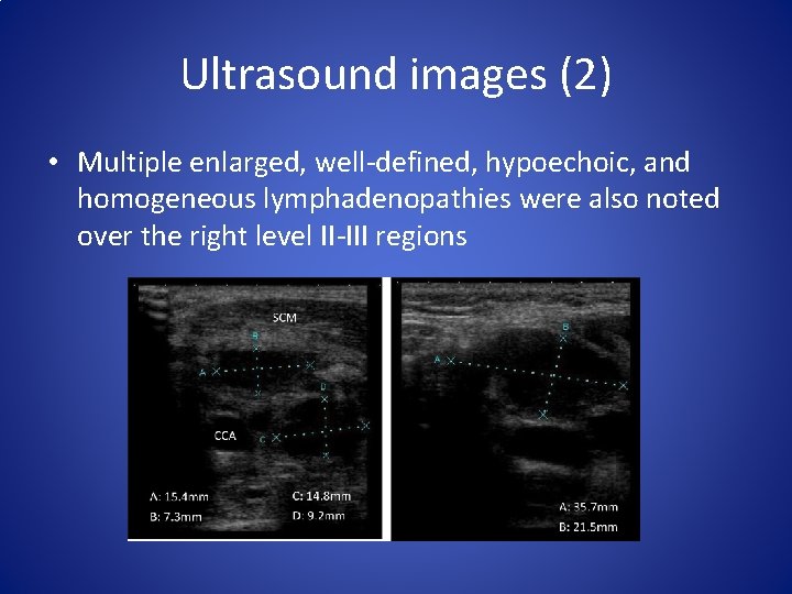 Ultrasound images (2) • Multiple enlarged, well-defined, hypoechoic, and homogeneous lymphadenopathies were also noted