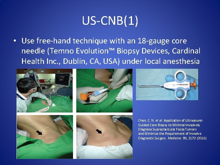 US-CNB(1) • Use free-hand technique with an 18 -gauge core needle (Temno Evolution™ Biopsy