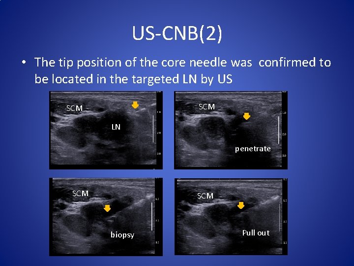 US-CNB(2) • The tip position of the core needle was confirmed to be located