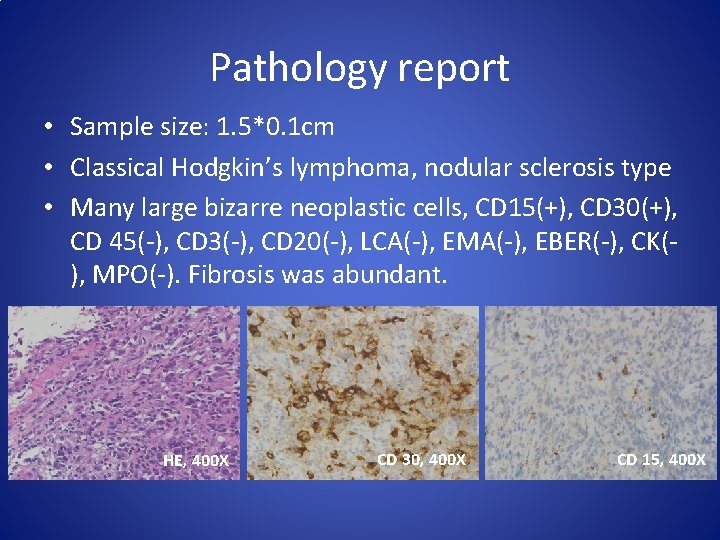 Pathology report • Sample size: 1. 5*0. 1 cm • Classical Hodgkin’s lymphoma, nodular