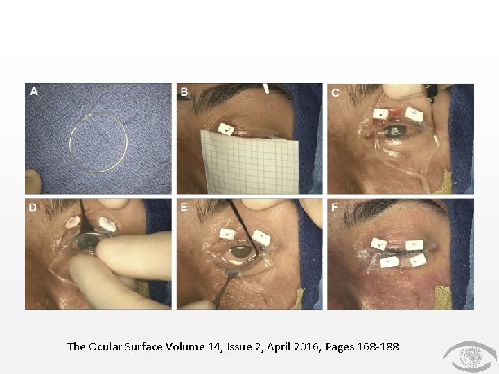 The Ocular Surface Volume 14, Issue 2, April 2016, Pages 168 -188 