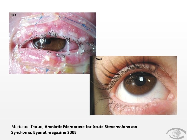 Marianne Doran, Amniotic Membrane for Acute Stevens-Johnson Syndrome. Eyenet magazine 2008 