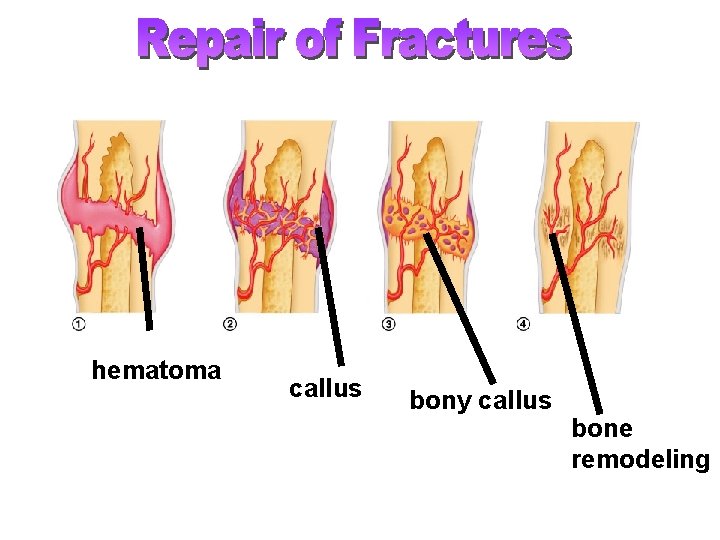 hematoma callus bony callus bone remodeling 