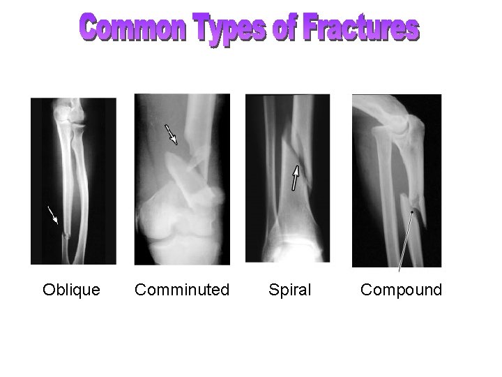 Oblique Comminuted Spiral Compound 