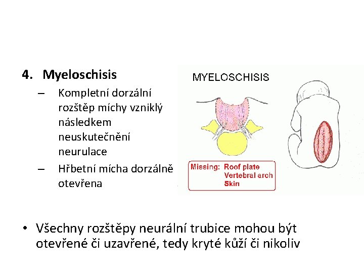 4. Myeloschisis – – Kompletní dorzální rozštěp míchy vzniklý následkem neuskutečnění neurulace Hřbetní mícha