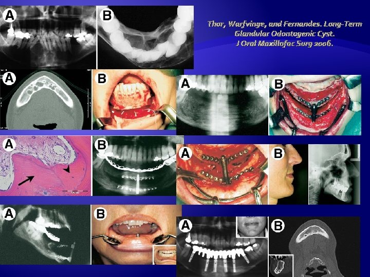 Thor, Warfvinge, and Fernandes. Long-Term Glandular Odontogenic Cyst. J Oral Maxillofac Surg 2006. 