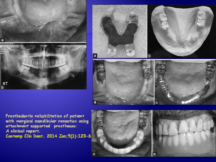 Prosthodontic rehabilitation of patient with marginal mandibular resection using attachment supported prostheses: A clinical