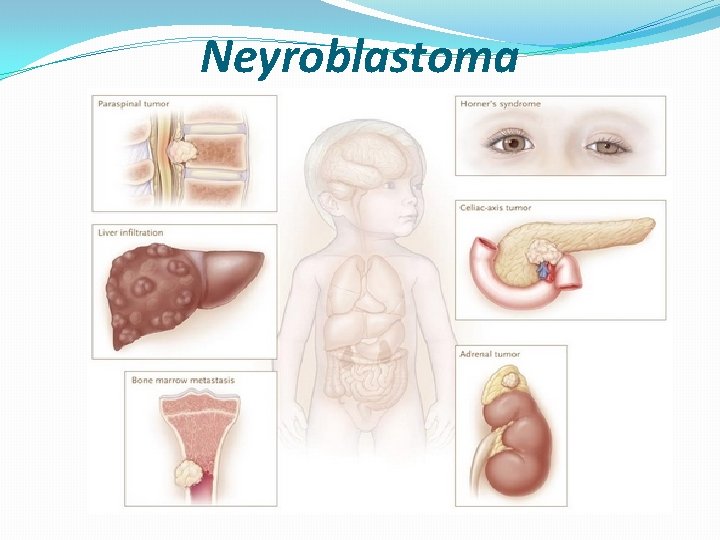 Neyroblastoma 