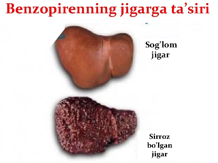 Benzopirenning jigarga ta’siri Sog’lom jigar Sirroz bo’lgan jigar 