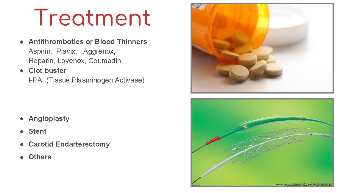 Treatment ● Antithrombotics or Blood Thinners Aspirin, Plavix, Aggrenox, Heparin, Lovenox, Coumadin ● Clot