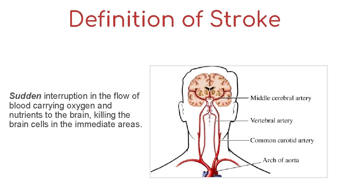 Definition of Stroke Sudden interruption in the flow of blood carrying oxygen and nutrients