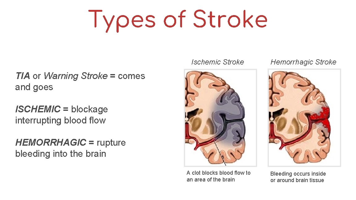 Types of Stroke Ischemic Stroke Hemorrhagic Stroke TIA or Warning Stroke = comes and
