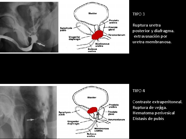 TIPO 3 Ruptura uretra posterior y diafragma. extravasación por uretra membranosa. TIPO 4 Contraste