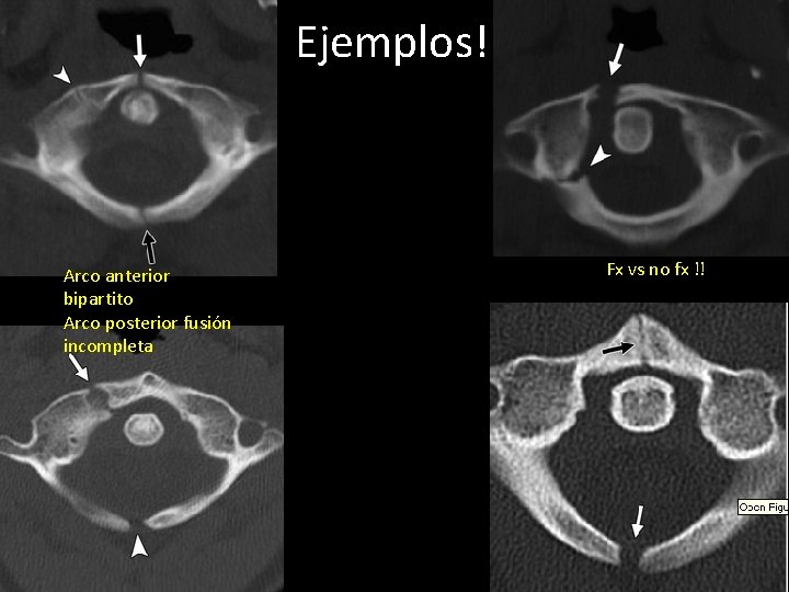 Ejemplos! Arco anterior bipartito Arco posterior fusión incompleta Fx vs no fx !! 