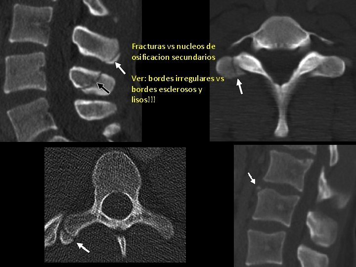 Fracturas vs nucleos de osificacion secundarios Ver: bordes irregulares vs bordes esclerosos y lisos!!!