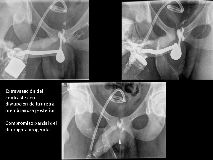 Extravasación del contraste con disrupción de la uretra membranosa posterior Compromiso parcial del diafragma