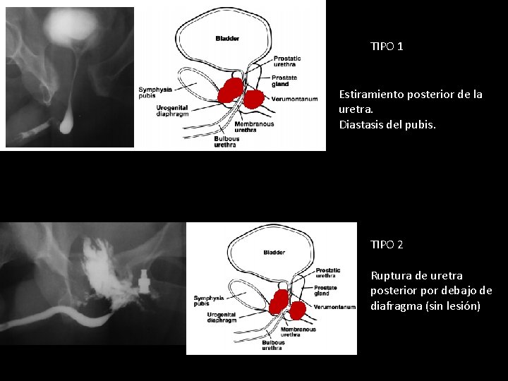 TIPO 1 Estiramiento posterior de la uretra. Diastasis del pubis. TIPO 2 Ruptura de