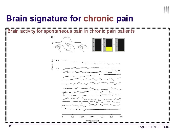 Brain signature for chronic pain Brain activity for spontaneous pain in chronic pain patients