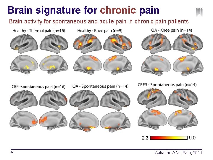 Brain signature for chronic pain Brain activity for spontaneous and acute pain in chronic