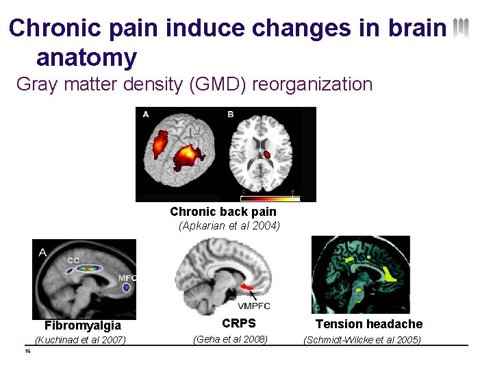 Chronic pain induce changes in brain anatomy Gray matter density (GMD) reorganization Chronic back