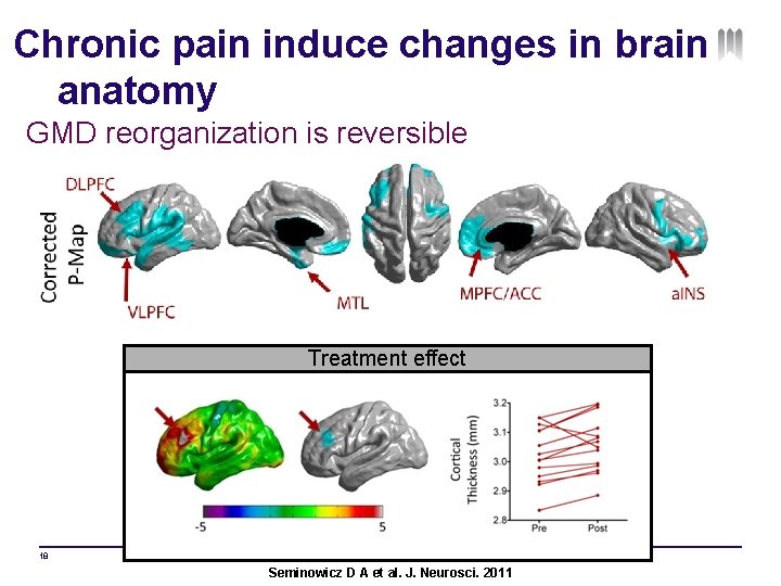 Chronic pain induce changes in brain anatomy GMD reorganization is reversible Treatment effect 18