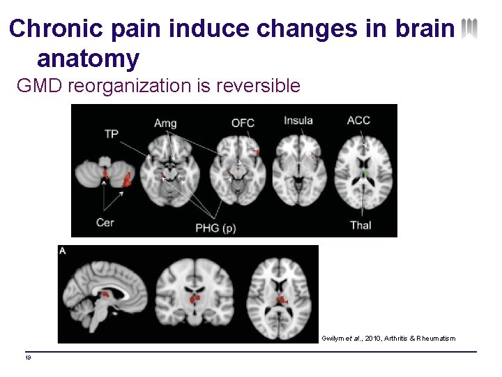 Chronic pain induce changes in brain anatomy GMD reorganization is reversible Gwilym et al.