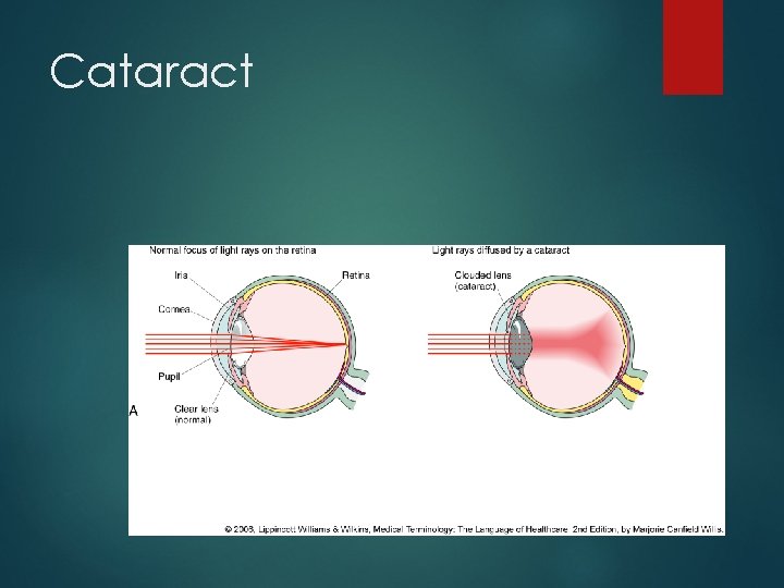 Cataract 