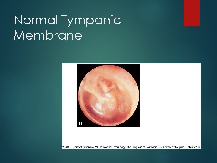 Normal Tympanic Membrane 