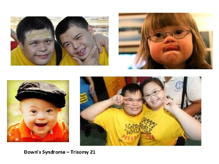 Down’s Syndrome – Trisomy 21 