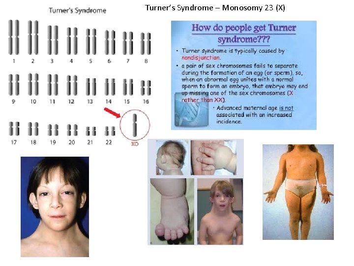 Turner’s Syndrome – Monosomy 23 (X) 