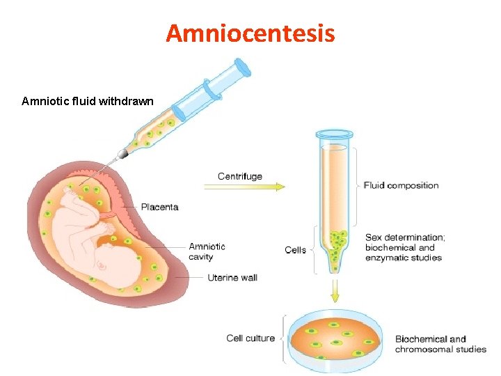 Amniocentesis Amniotic fluid withdrawn 