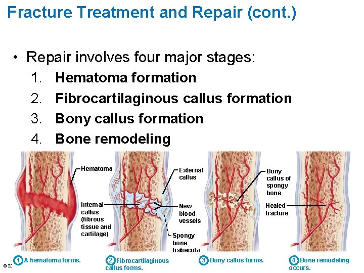 Fracture Treatment and Repair (cont. ) • Repair involves four major stages: 1. 2.