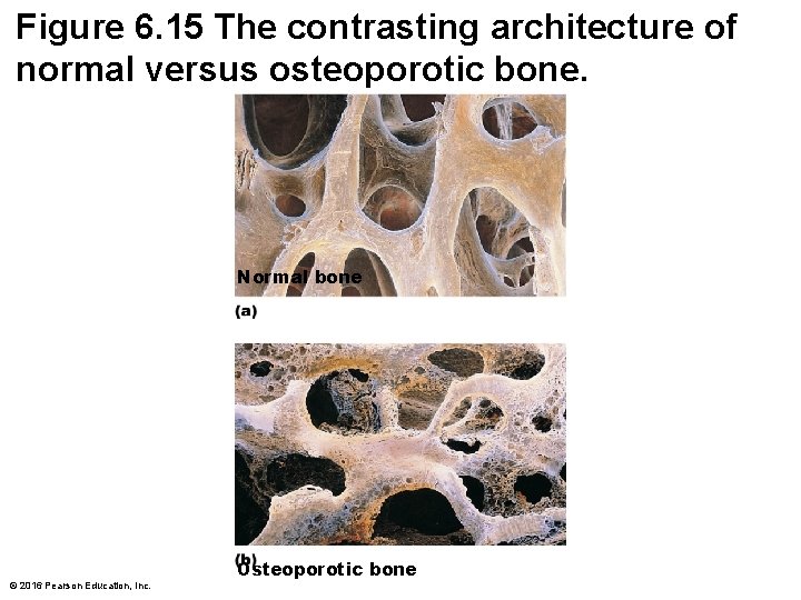 Figure 6. 15 The contrasting architecture of normal versus osteoporotic bone. Normal bone ©