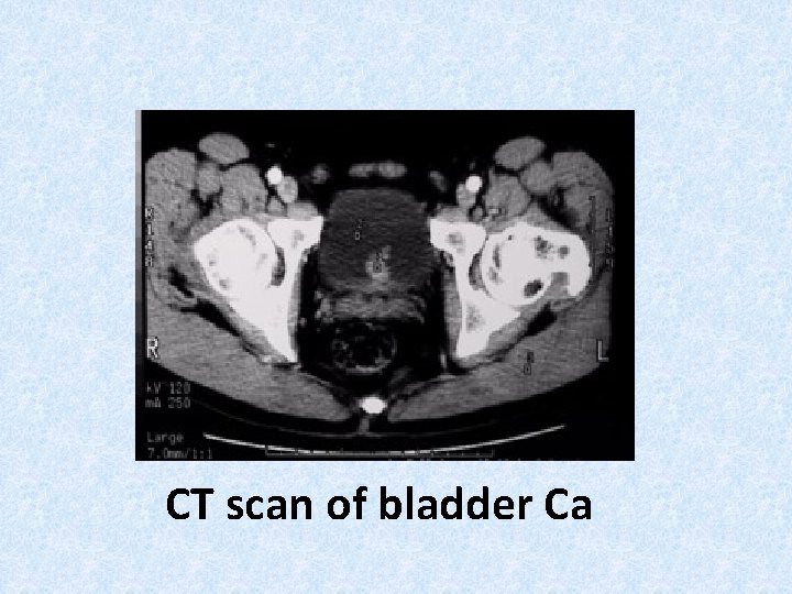 CT scan of bladder Ca 