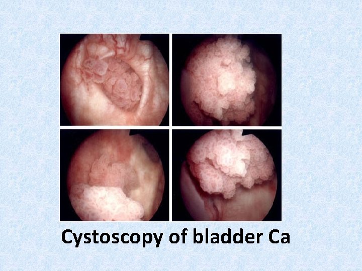 Cystoscopy of bladder Ca 