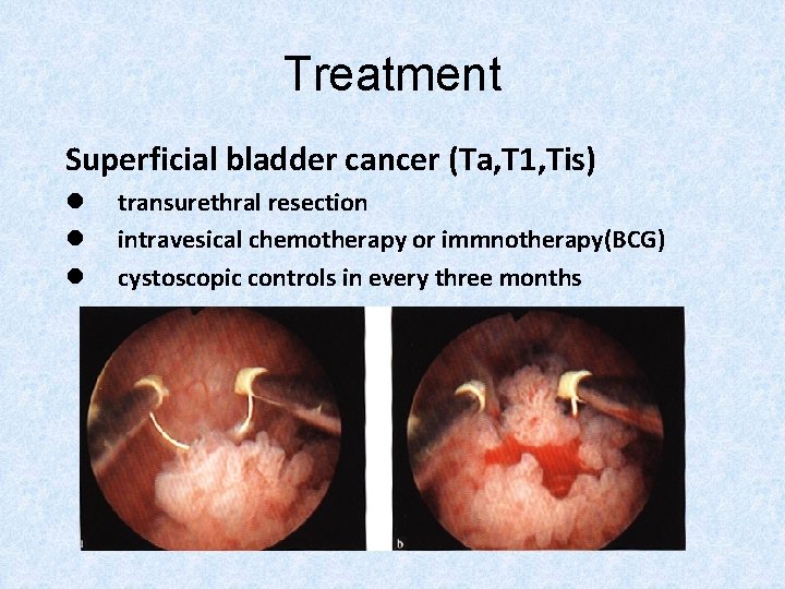 Treatment Superficial bladder cancer (Ta, T 1, Tis) l l l transurethral resection intravesical