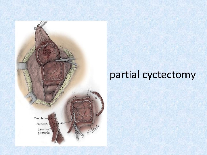 partial cyctectomy 