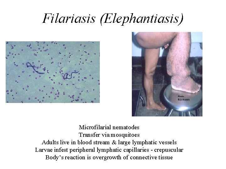 Filariasis (Elephantiasis) Microfilarial nematodes Transfer via mosquitoes Adults live in blood stream & large