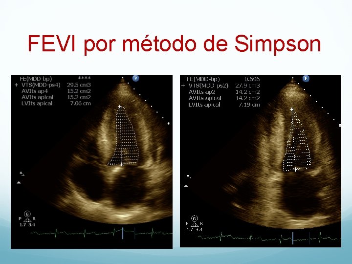 Disfuncin ventricular subclnica por speckle tracking en pacientes