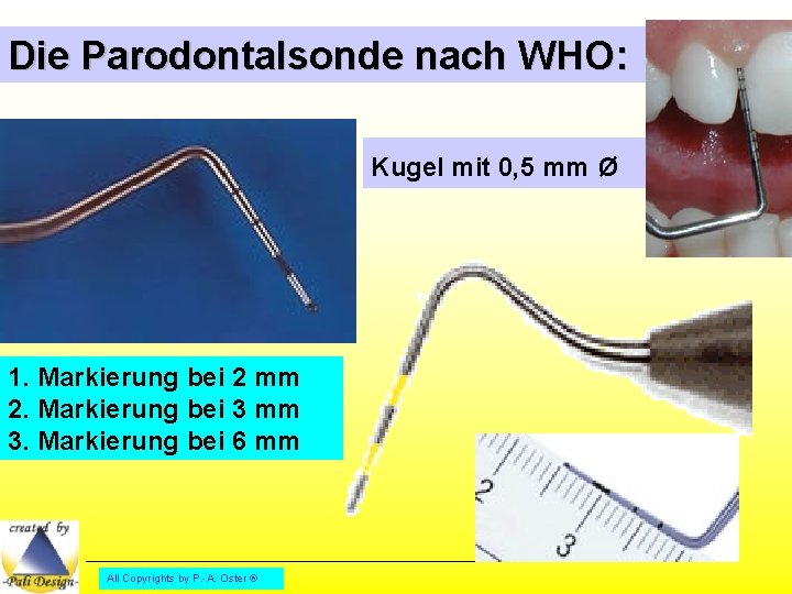 Die Parodontalsonde nach WHO: Kugel mit 0, 5 mm ø 1. Markierung bei 2