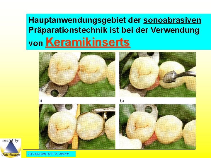 Hauptanwendungsgebiet der sonoabrasiven Präparationstechnik ist bei der Verwendung von Keramikinserts All Copyrights by P.