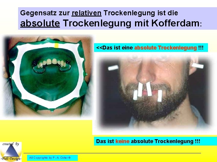 Gegensatz zur relativen Trockenlegung ist die absolute Trockenlegung mit Kofferdam: <<Das ist eine absolute