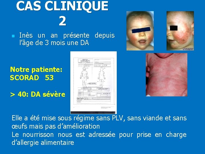 CAS CLINIQUE 2 n Inès un an présente depuis l’âge de 3 mois une