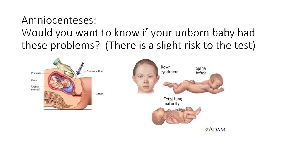 Amniocenteses: Would you want to know if your unborn baby had these problems? (There