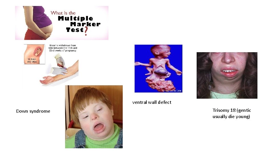 ventral wall defect Down syndrome Trisomy 18 (gentic usually die young) 