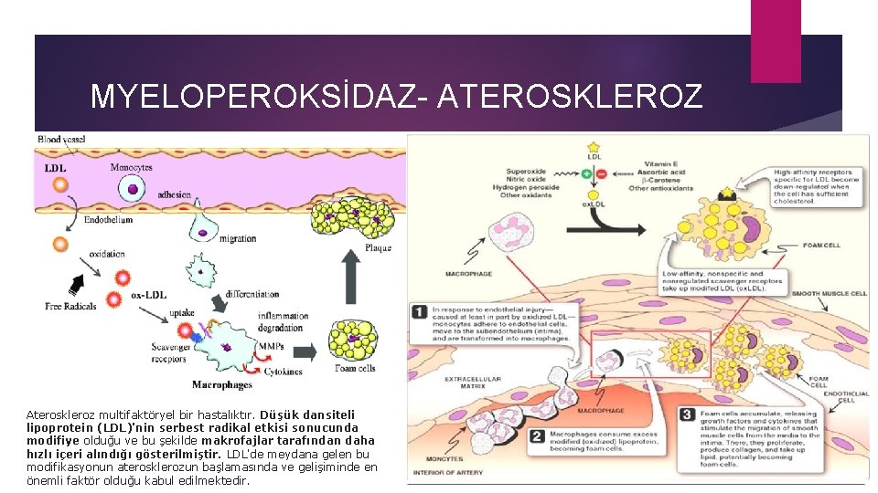 MYELOPEROKSİDAZ- ATEROSKLEROZ Ateroskleroz multifaktöryel bir hastalıktır. Düşük dansiteli lipoprotein (LDL)'nin serbest radikal etkisi sonucunda
