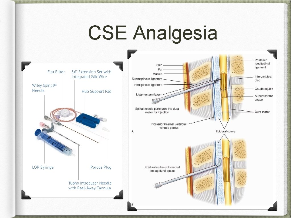 CSE Analgesia 