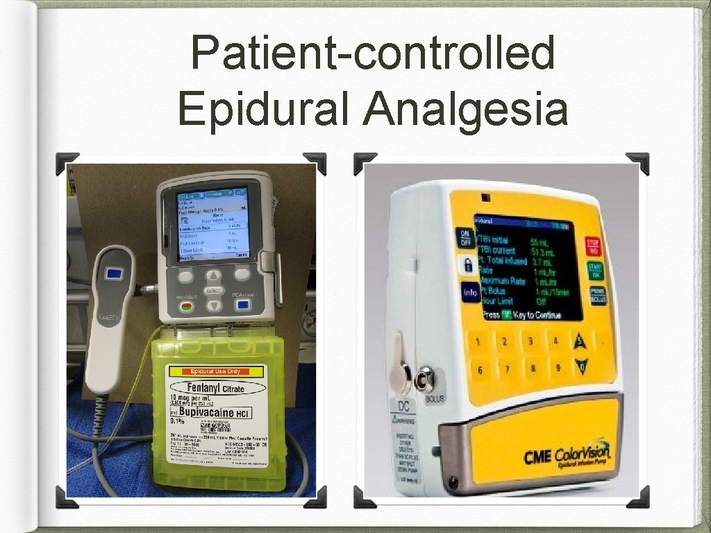 Patient-controlled Epidural Analgesia 