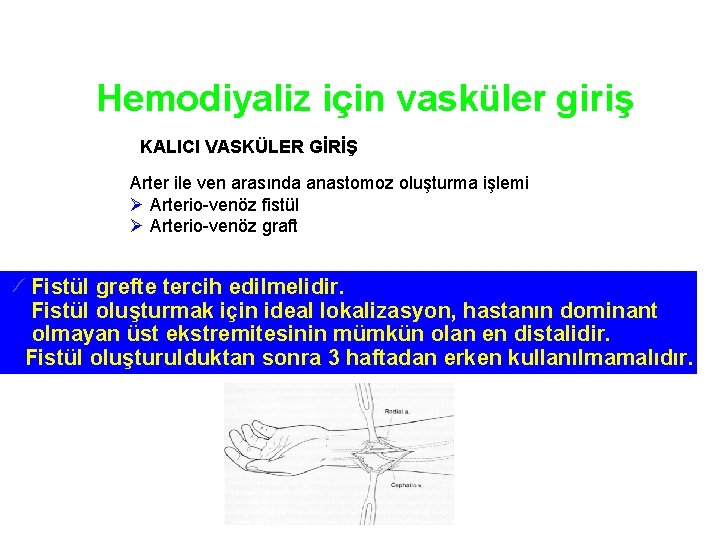 Hemodiyaliz için vasküler giriş KALICI VASKÜLER GİRİŞ Arter ile ven arasında anastomoz oluşturma işlemi